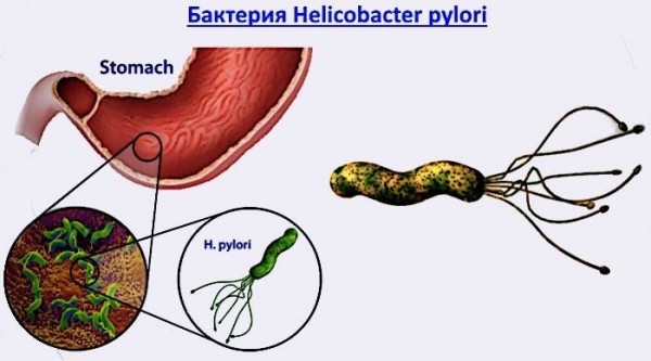 Как и чем лечить гастрит желудка