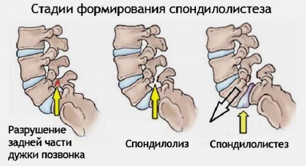 Воспаление седалищного нерва - симптомы и лечение медикаментозными и народными средствами