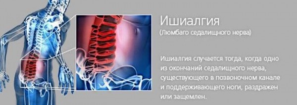 Воспаление седалищного нерва - симптомы и лечение медикаментозными и народными средствами