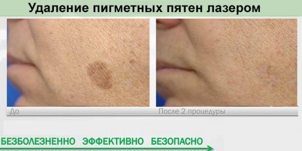 Как избавиться от пигментных пятен на коже лица и тела