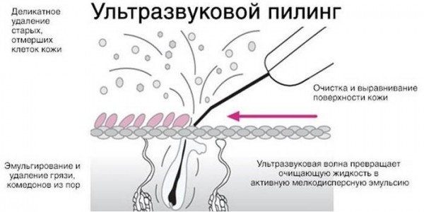 Как быстро избавиться от прыщей на лице в домашних условиях