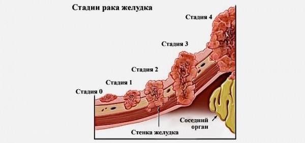 Первые симптомы рака желудка