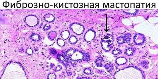 Фиброзно-кистозная мастопатия - симптомы и лечение. Признаки заболевания