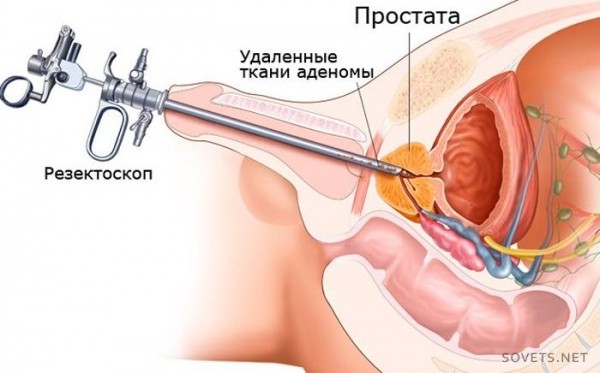 Лечение аденомы простаты - препараты и народные средства. Как лечить аденому простаты у мужчин