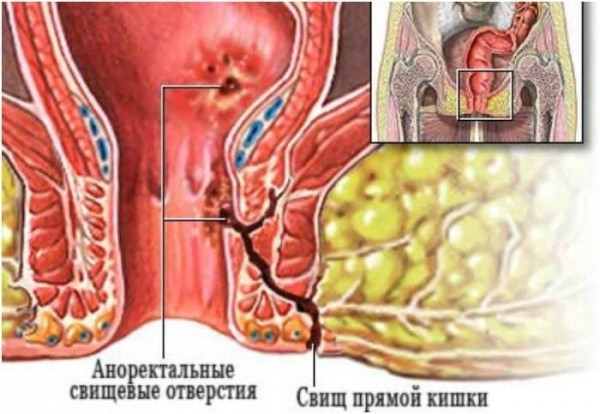 Чем и как лечить парапроктит – подкожный, хронический, гнойный